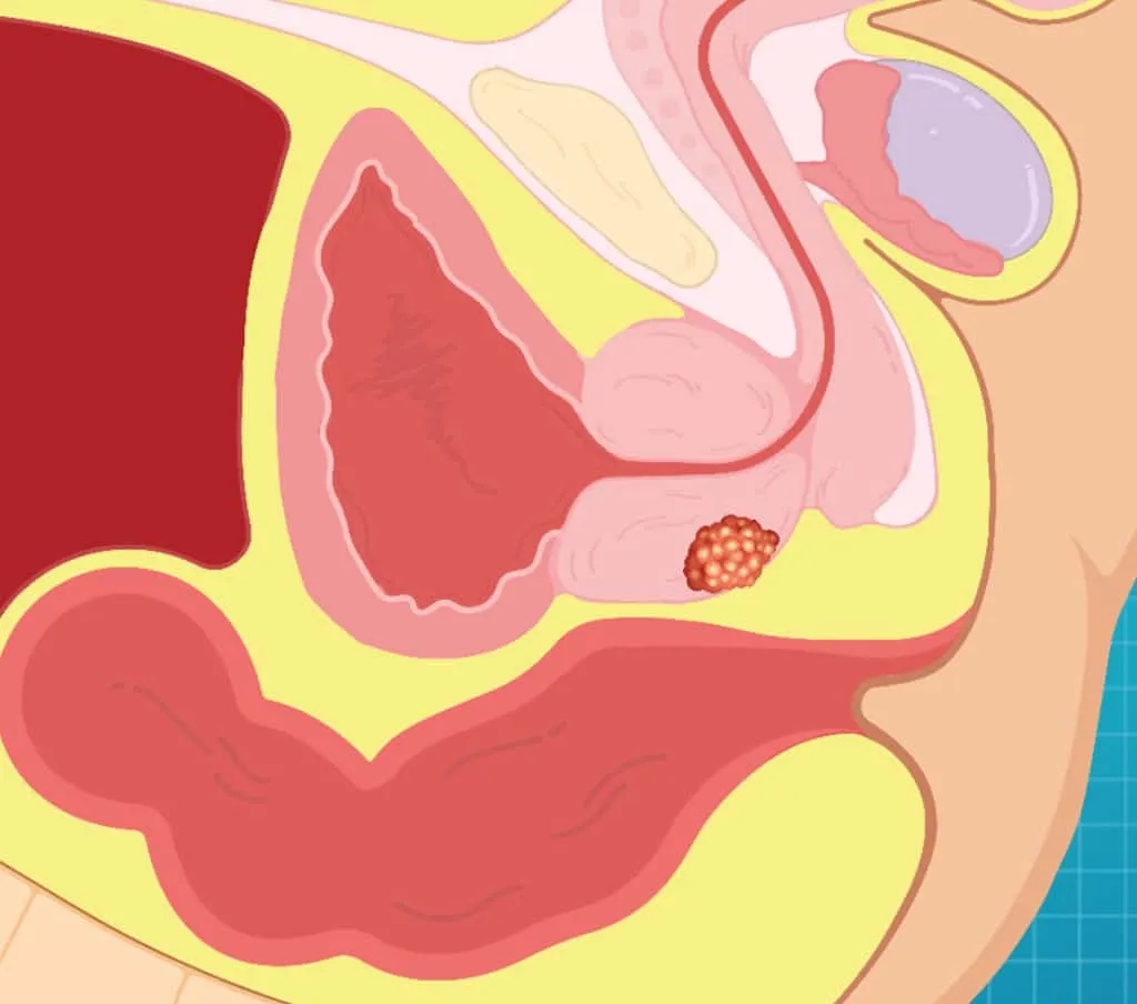 Illustrating image showing a prostate