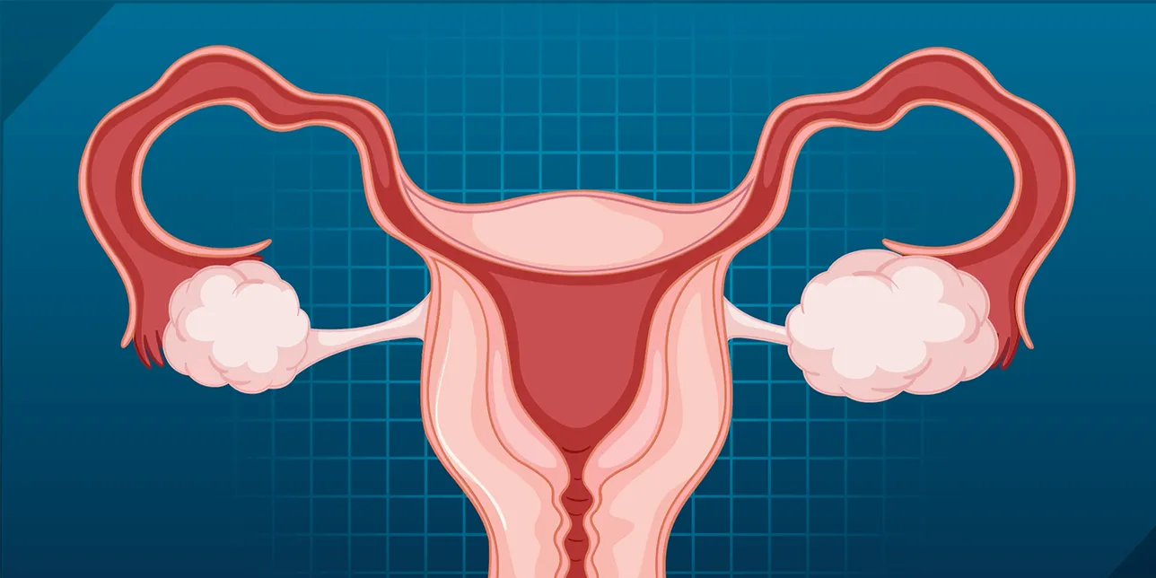 Illustration of diagram of the female reproductive system showing ovaries, fallopian tubes, uterus, cervix, and vagina.